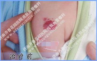 肩膀肿瘤图片,图片解析与疾病概述